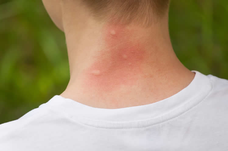 What You Need To Know About Mosquito Bites 