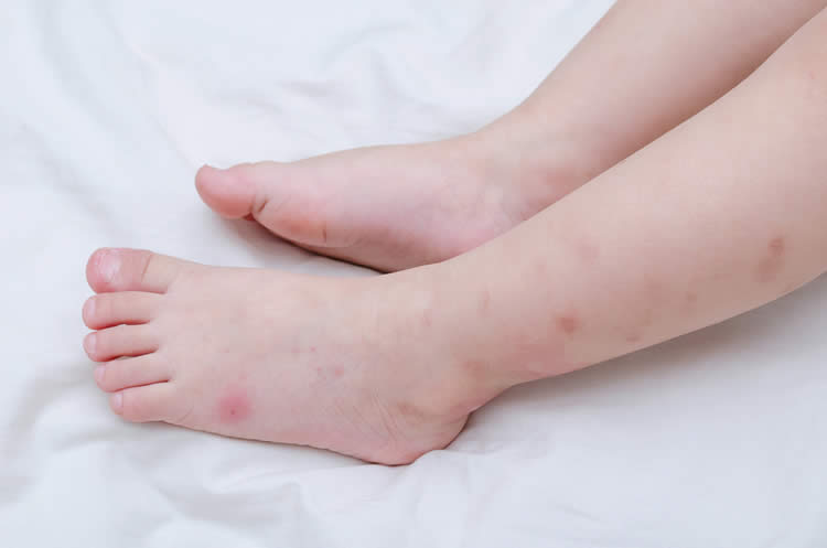 Why Mosquitoes Love to Bite Our Feet and Ankles